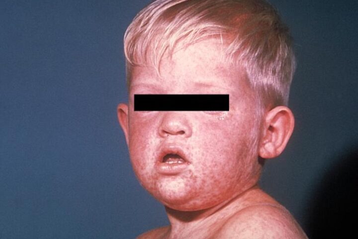 A DIFFERENT POINT OF VIEW: Measles